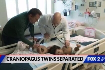Conjoined twins successfully separated in St. Louis - Modern Ghana