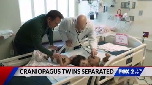 Conjoined twins successfully separated in St. Louis - Modern Ghana